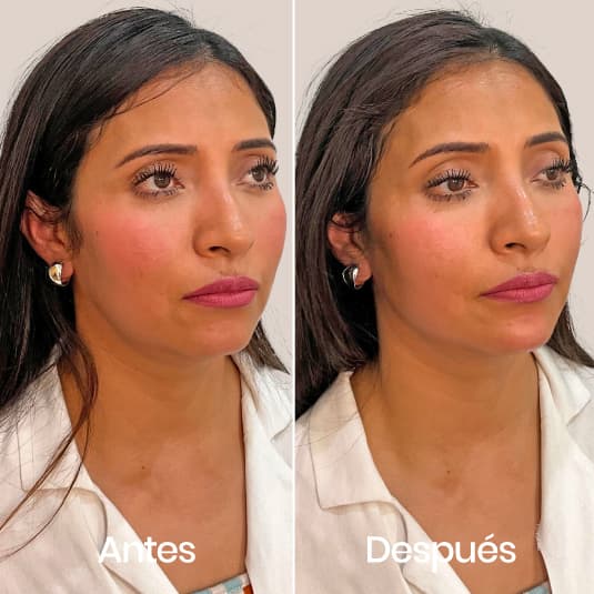Marcación mandibular antes y después - Resultado 1 - Holaglow