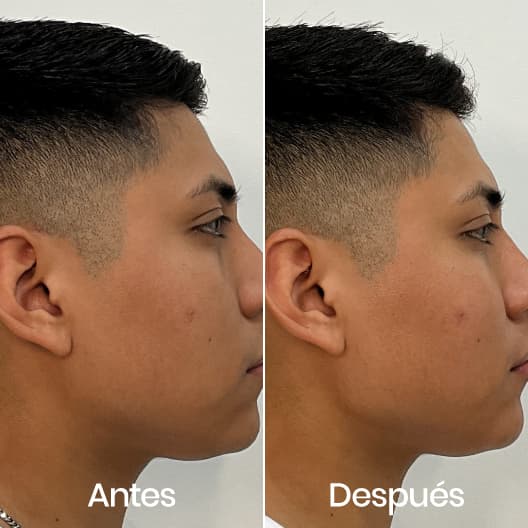 Marcación mandibular antes y después - Resultado 2 - Holaglow