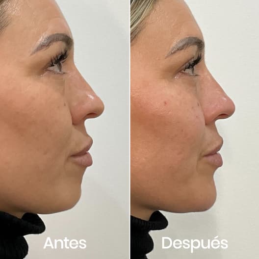 antes y despues Proyección de mentón