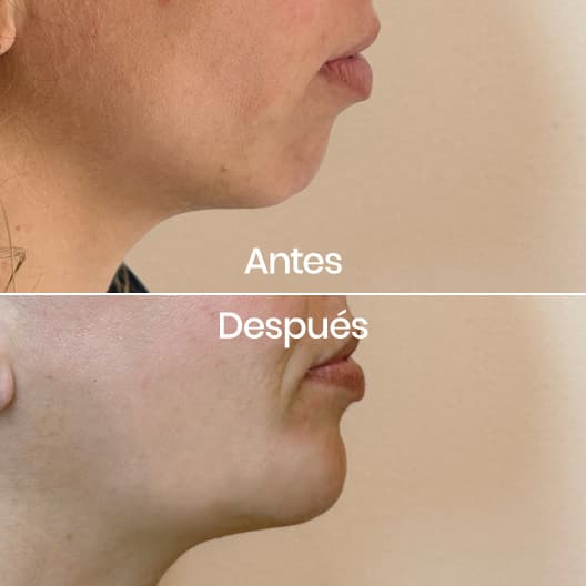antes y despues Proyección de mentón