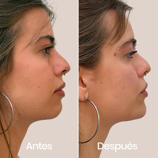 antes y despues Proyección de mentón