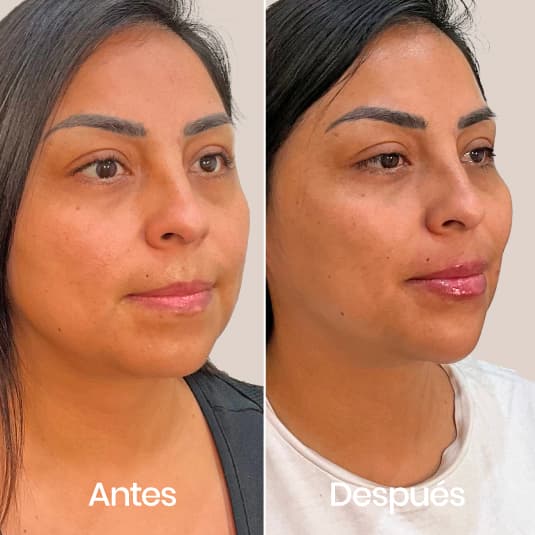 antes y despues Proyección de mentón