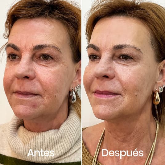 Proyección de pómulos antes y después - Resultado 3 - Holaglow