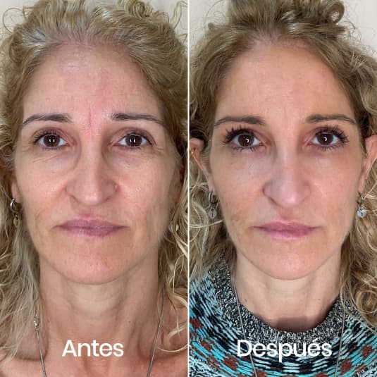 Proyección de pómulos antes y después - Resultado 5 - Holaglow
