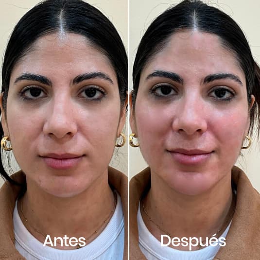 Proyección de pómulos antes y después - Resultado 2 - Holaglow
