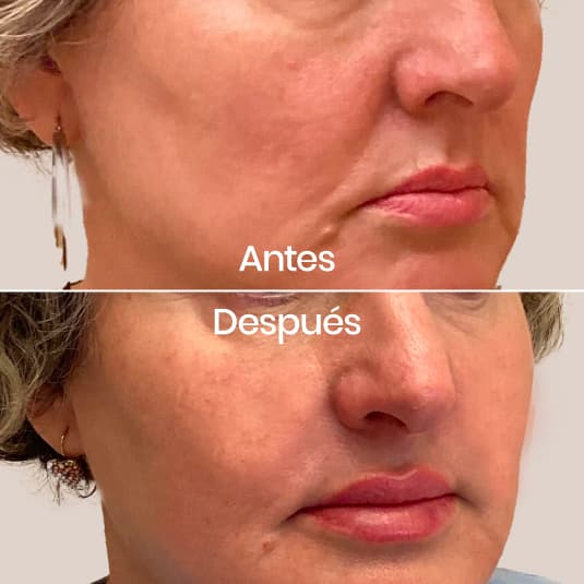 Proyección de pómulos antes y después - Resultado 4 - Holaglow