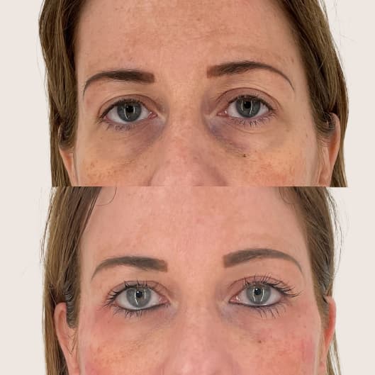 Relleno de ojeras antes y después - Resultado 1 - Holaglow