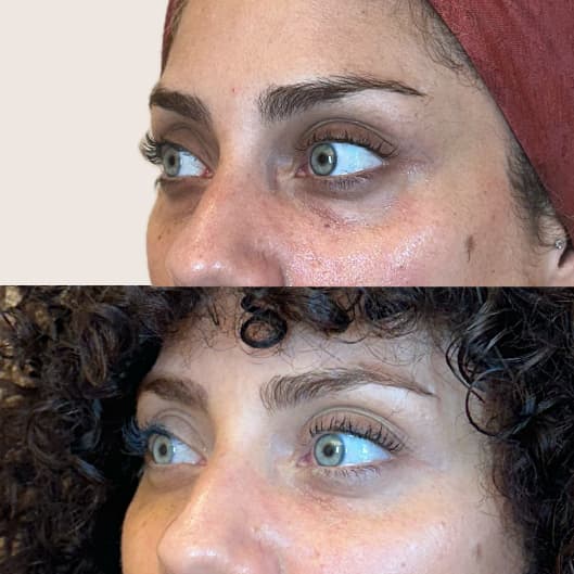 Relleno de ojeras antes y después - Resultado 6 - Holaglow