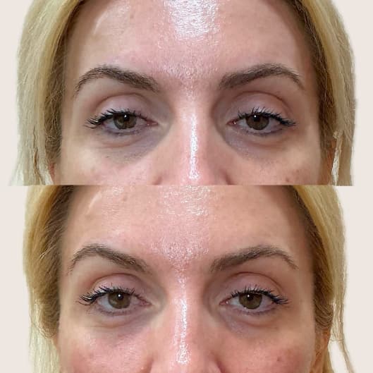 Relleno de ojeras antes y después - Resultado 11 - Holaglow