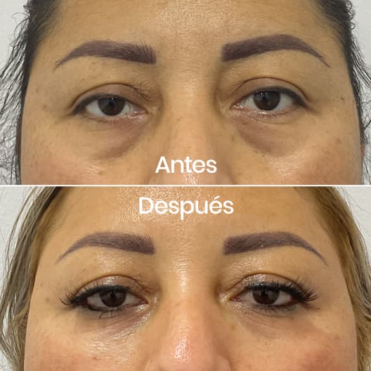Relleno de ojeras antes y después - Resultado 8 - Holaglow