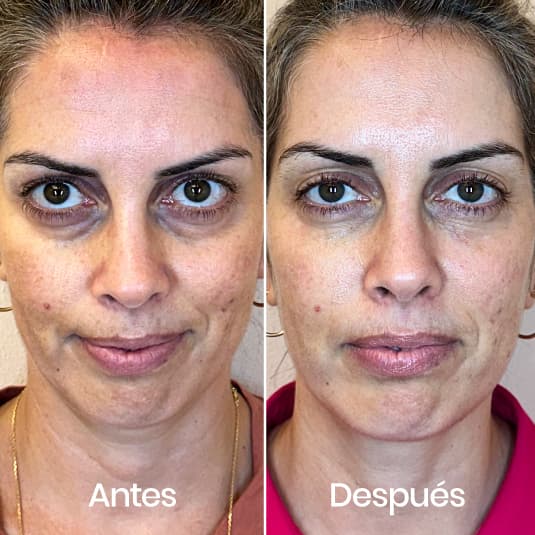 Relleno de ojeras antes y después - Resultado 5 - Holaglow