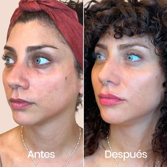 Relleno de ojeras antes y después - Resultado 6 - Holaglow