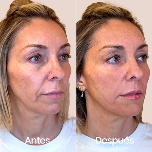 Relleno de ojeras antes y después - Resultado 7 - Holaglow