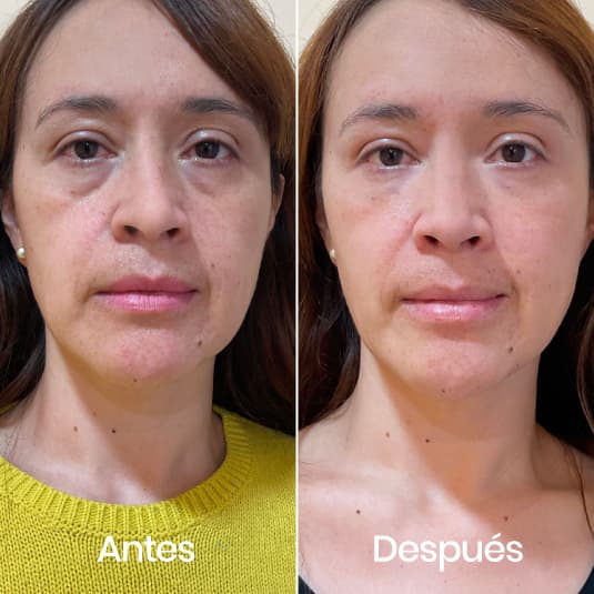 Relleno de ojeras antes y después - Resultado 10 - Holaglow