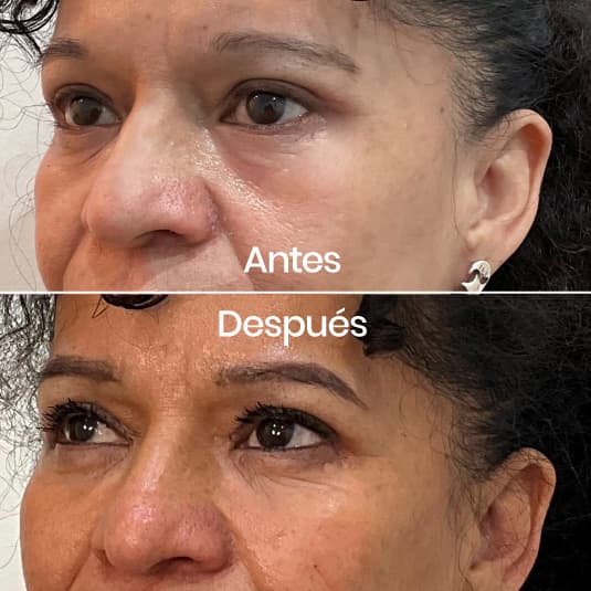 Relleno de ojeras antes y después - Resultado 9 - Holaglow
