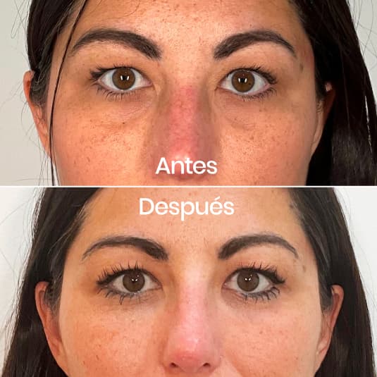 Relleno de ojeras antes y después - Resultado 3 - Holaglow