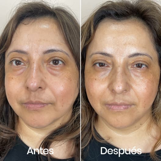 Relleno de ojeras antes y después - Resultado 4 - Holaglow
