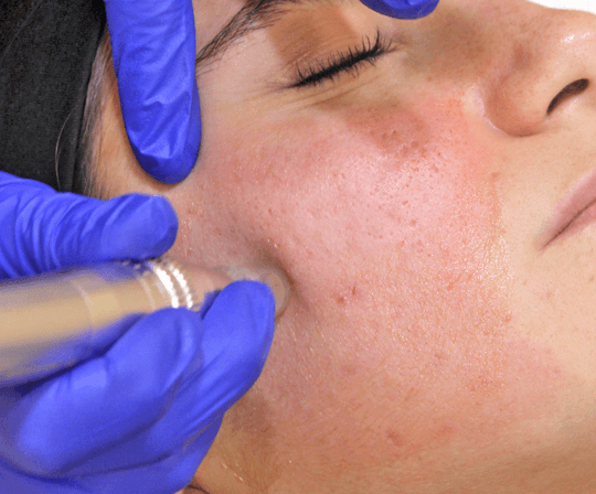 Microneedling