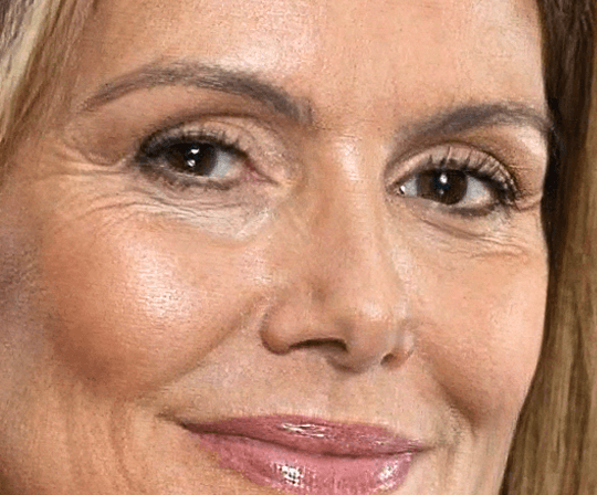 Armonización facial