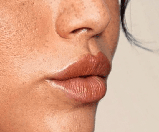 Aumento de labios