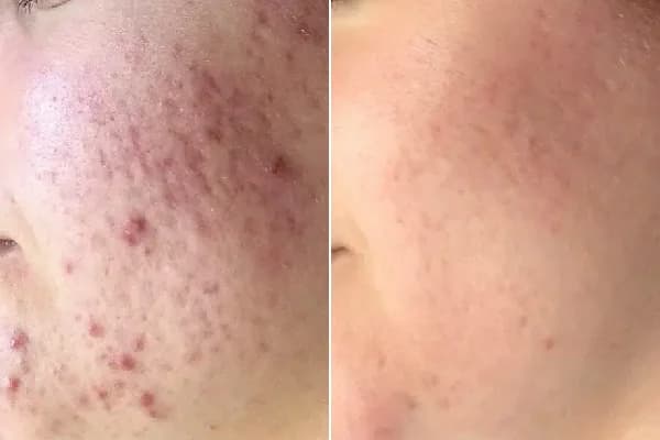 Antes y después Derma by Holaglow