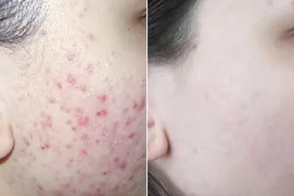 Antes y después Derma by Holaglow