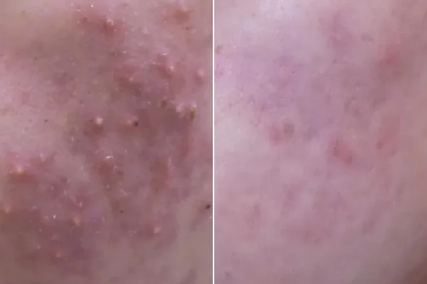 Antes y después Derma by Holaglow