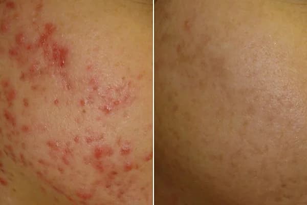 Antes y después Derma by Holaglow