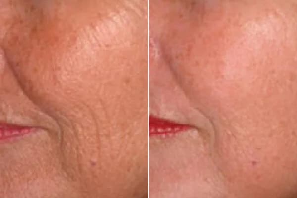 Antes y después Derma by Holaglow