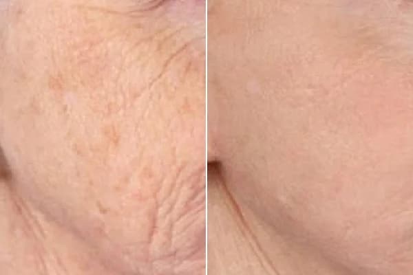 Antes y después Derma by Holaglow