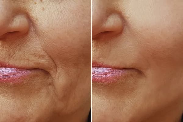 Antes y después Derma by Holaglow