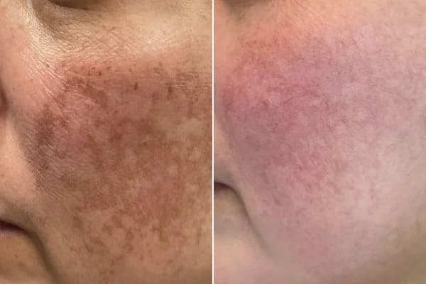 Antes y después Derma by Holaglow
