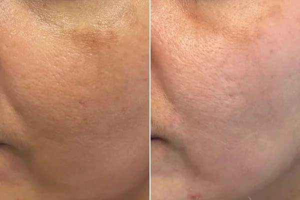 Antes y después Derma by Holaglow