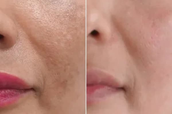Antes y después Derma by Holaglow