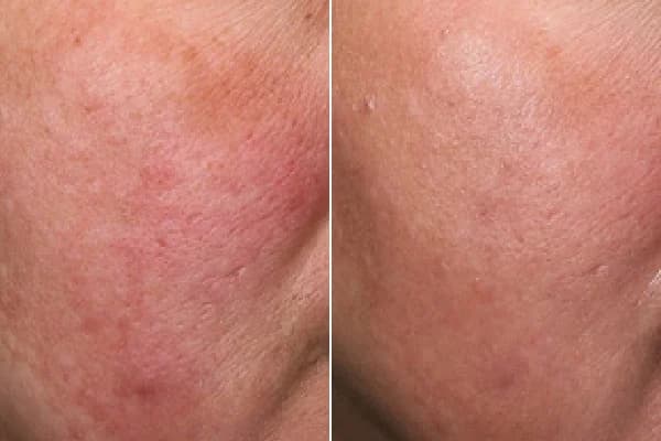 Antes y después Derma by Holaglow