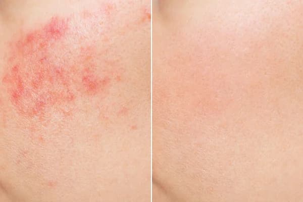 Antes y después Derma by Holaglow