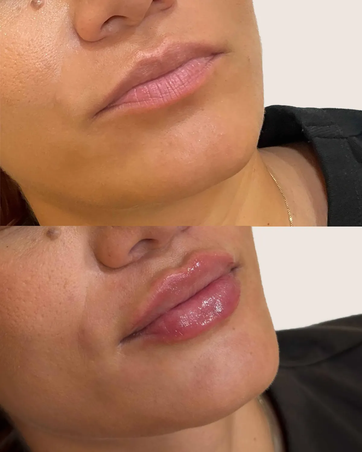 antes y despues Labios