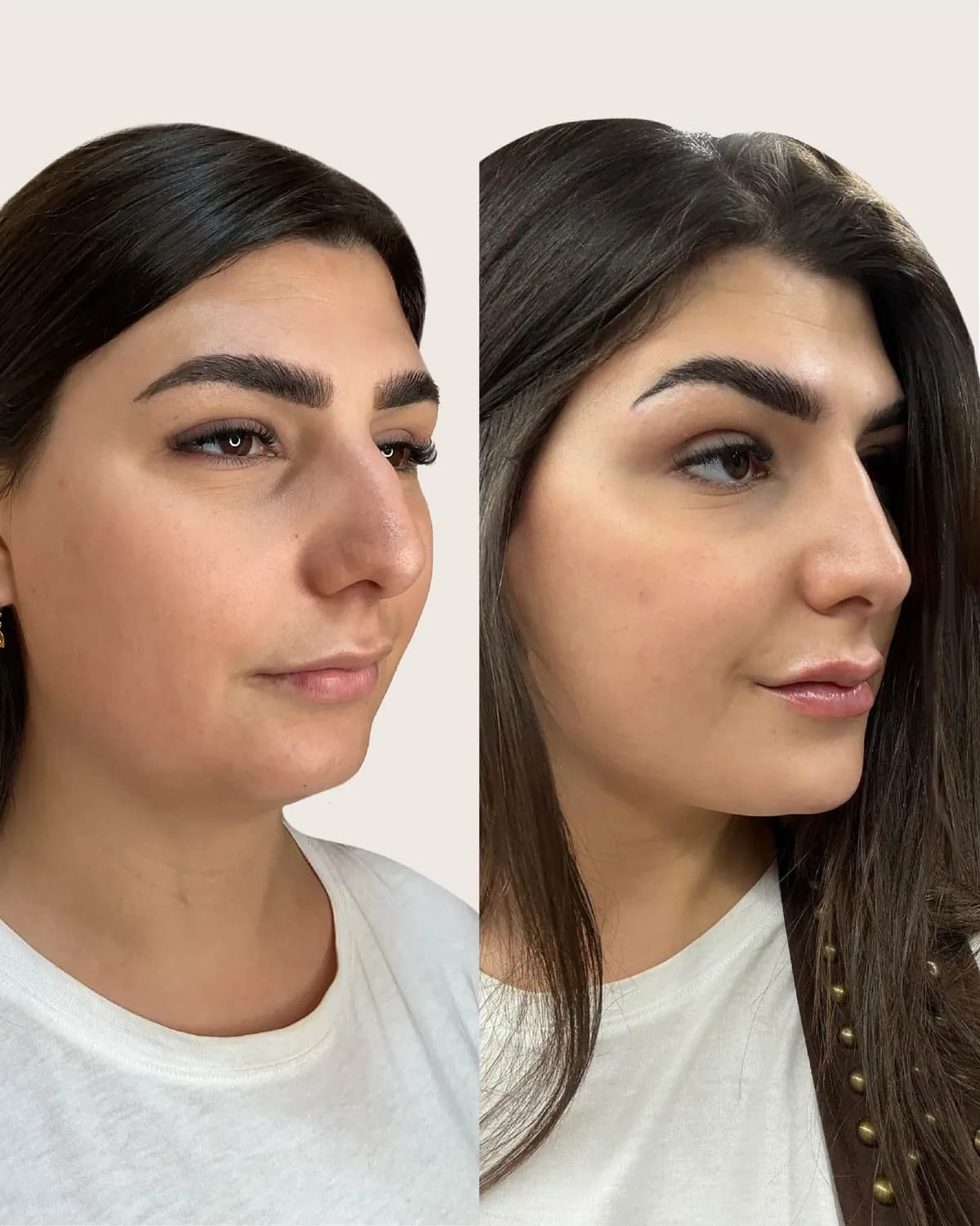 antes y despues Armonización facial