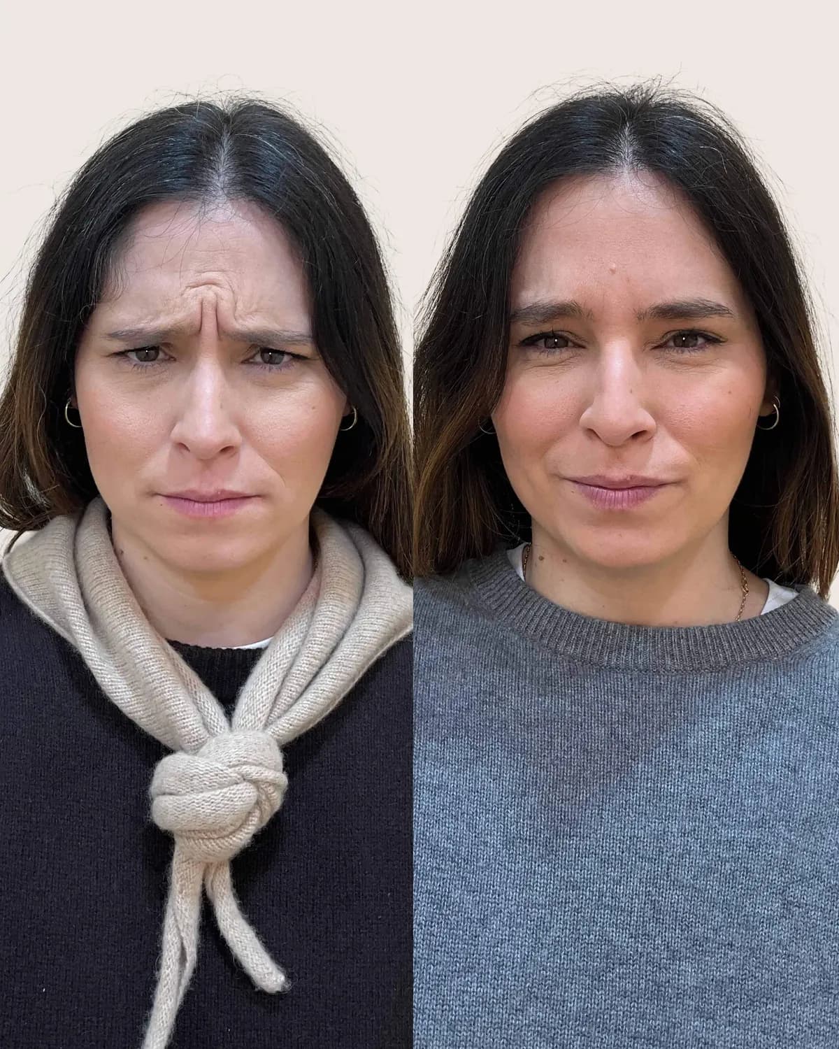 antes y despues Líneas de expresión: entrecejo