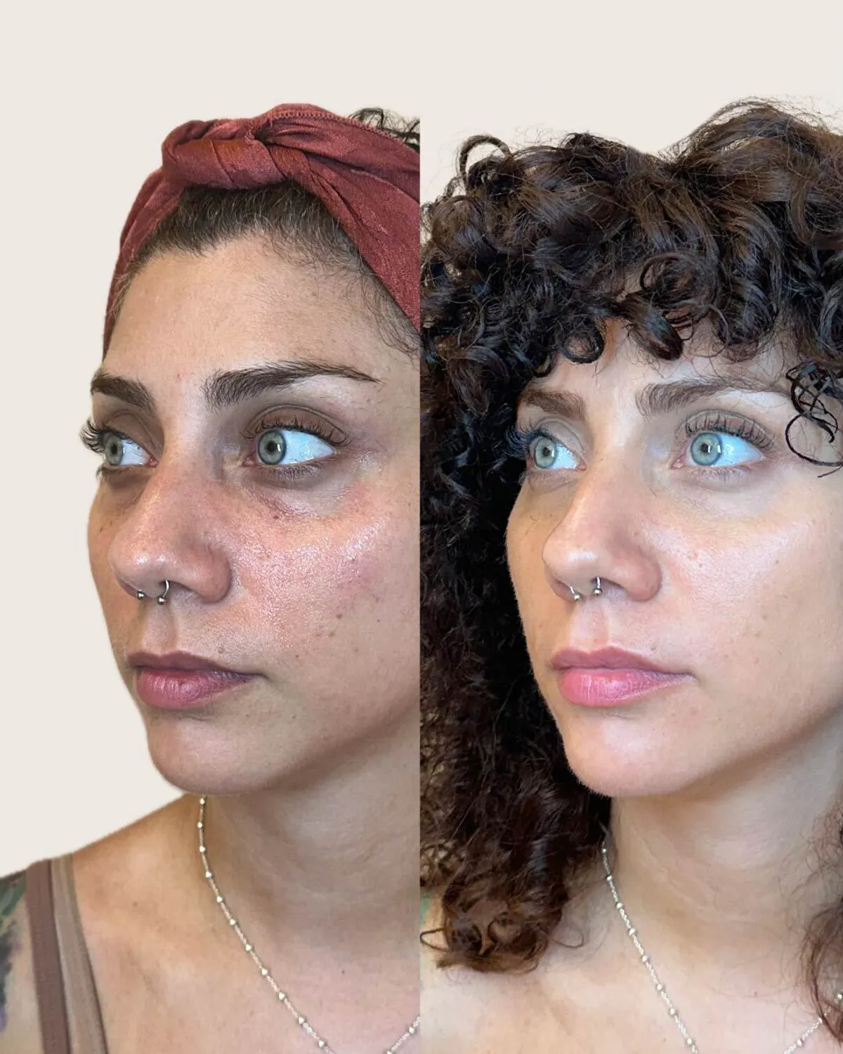 antes y despues Ojeras