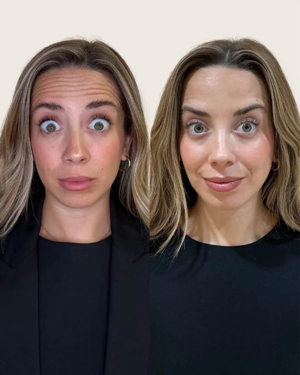 antes y despues Líneas de expresión: frente