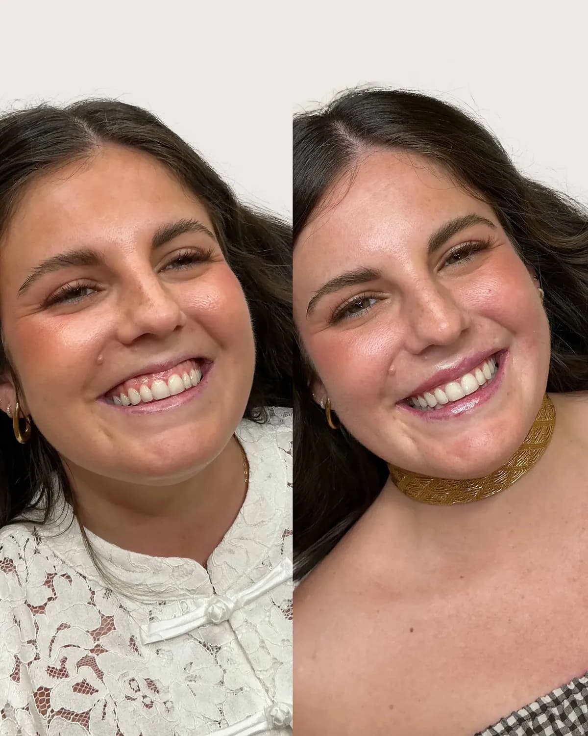 antes y despues Sonrisa gingival