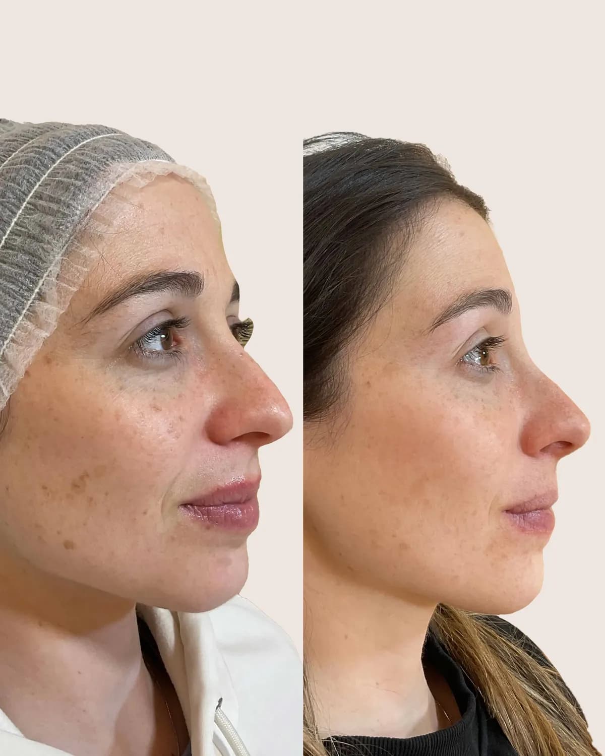 antes y despues IPL