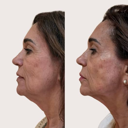 antes y despues Armonización facial