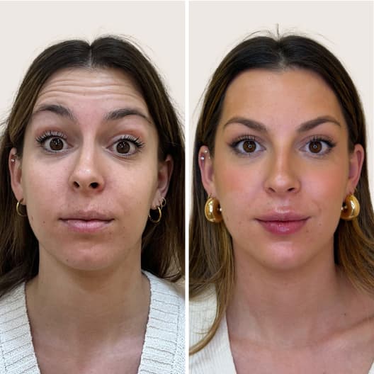 antes y despues Armonización facial