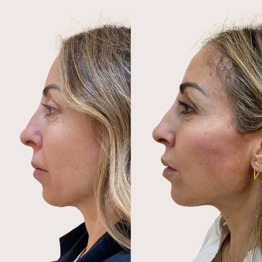 antes y despues Armonización facial