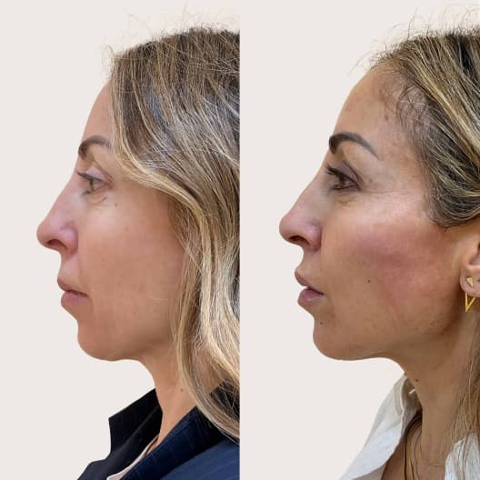 antes y despues Armonización facial Basic