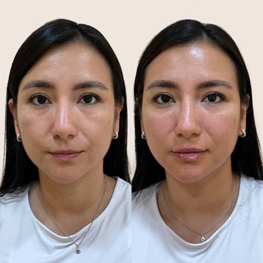 antes y despues Armonización facial Basic