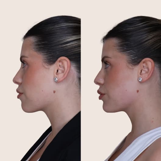 antes y despues Armonización facial Basic