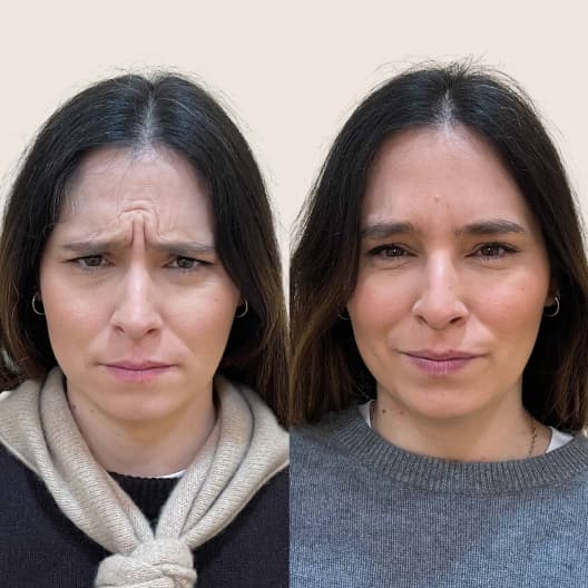 antes y despues Arrugas expresión: Frente, entrecejo y patas de gallo